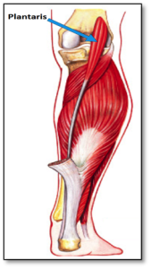 Plantaris muscle rupture